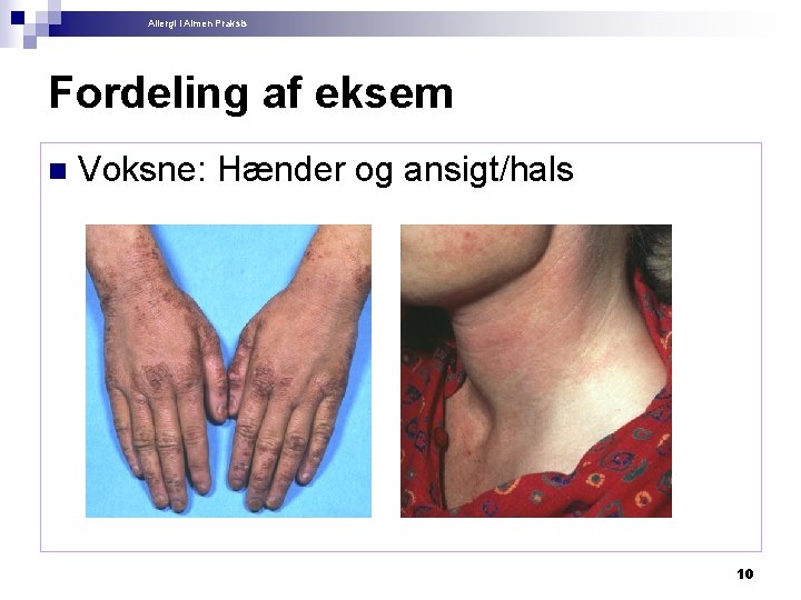 Allergi i Almen Praksis Fordeling af eksem n Voksne: Hænder og ansigt/hals 10 