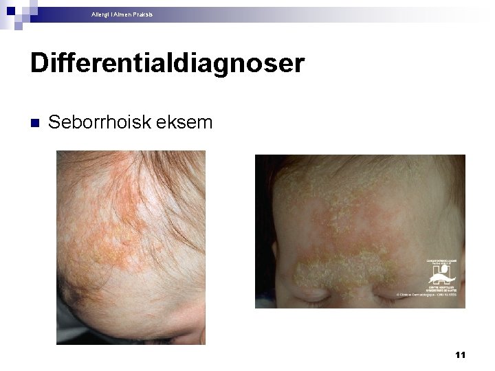 Allergi i Almen Praksis Differentialdiagnoser n Seborrhoisk eksem 11 