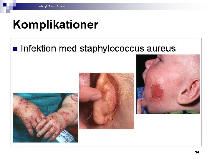 Allergi i Almen Praksis Komplikationer n Infektion med staphylococcus aureus 14 