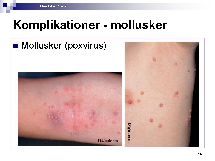 Allergi i Almen Praksis Komplikationer - mollusker n Mollusker (poxvirus) 15 