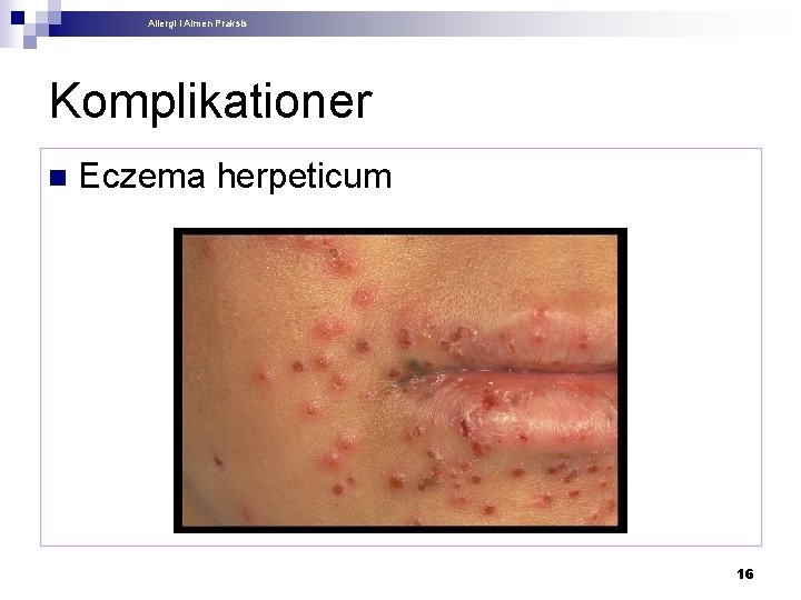 Allergi i Almen Praksis Komplikationer n Eczema herpeticum 16 