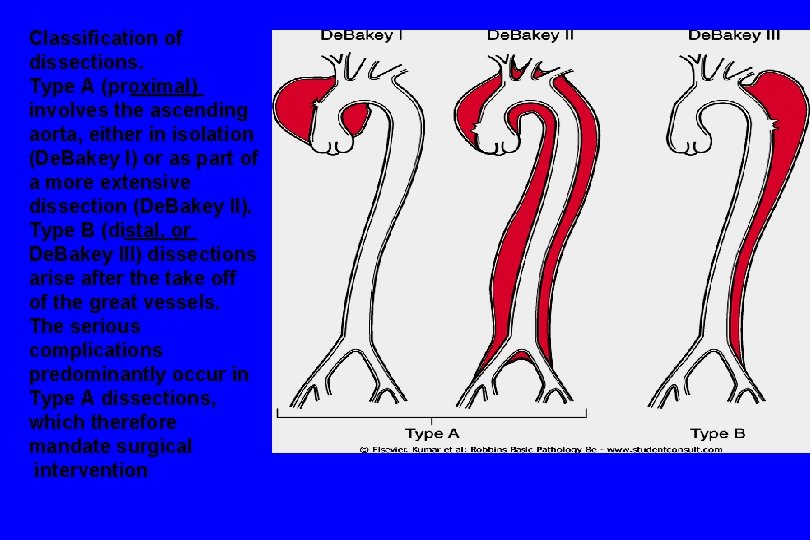 Classification of dissections. Type A (proximal) involves the ascending aorta, either in isolation (De.