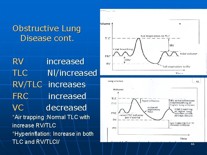 Obstructive Lung Disease cont. RV TLC RV/TLC FRC VC increased Nl/increased increases increased decreased