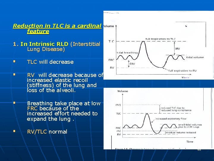 Reduction in TLC is a cardinal feature 1. In Intrinsic RLD (Interstitial Lung Disease)