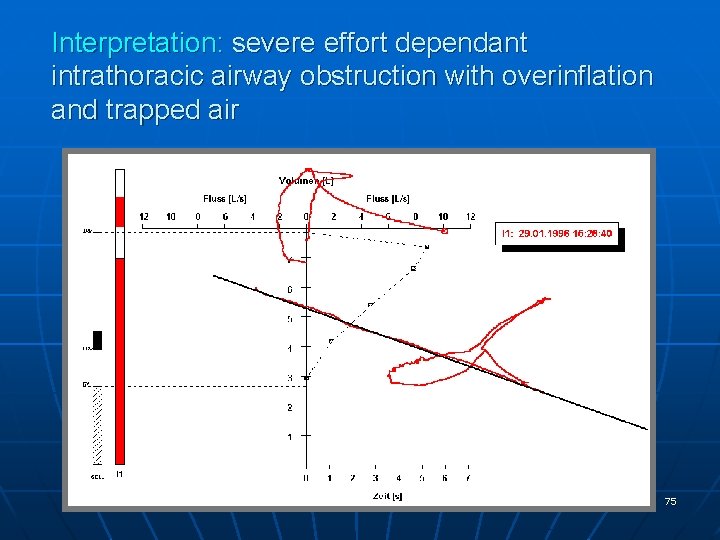Interpretation: severe effort dependant intrathoracic airway obstruction with overinflation and trapped air 75 