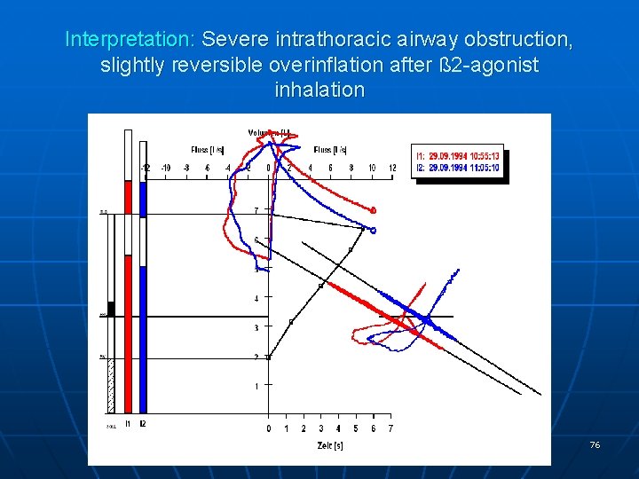 Interpretation: Severe intrathoracic airway obstruction, slightly reversible overinflation after ß 2 -agonist inhalation 76