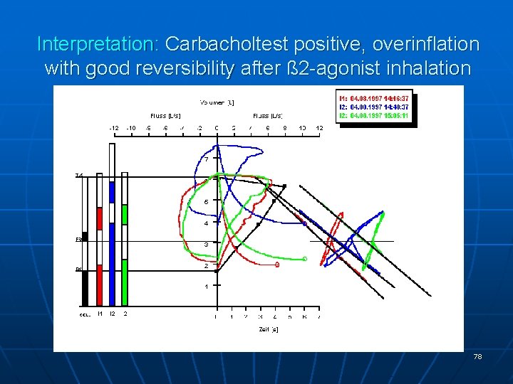 Interpretation: Carbacholtest positive, overinflation with good reversibility after ß 2 -agonist inhalation 78 