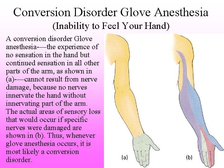 Conversion Disorder Glove Anesthesia (Inability to Feel Your Hand) A conversion disorder Glove anesthesia-—the