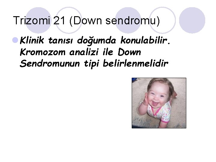 Trizomi 21 (Down sendromu) l Klinik tanısı doğumda konulabilir. Kromozom analizi ile Down Sendromunun