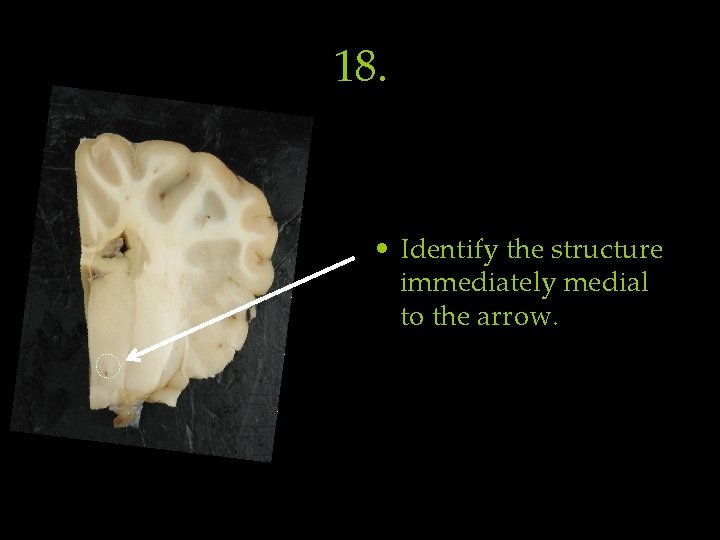 18. • Identify the structure immediately medial to the arrow. 