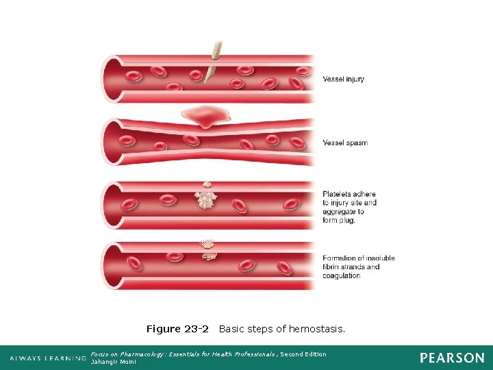 Figure 23 -2 Basic steps of hemostasis. Focus on Pharmacology: Essentials for Health Professionals