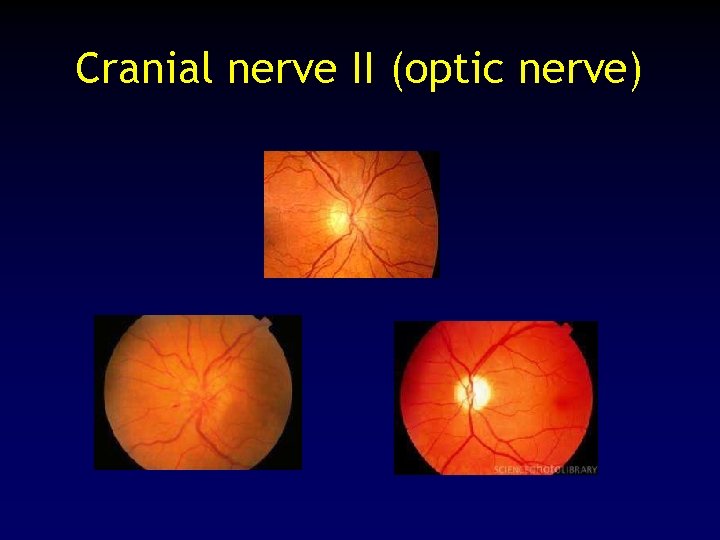 Cranial nerve II (optic nerve) 
