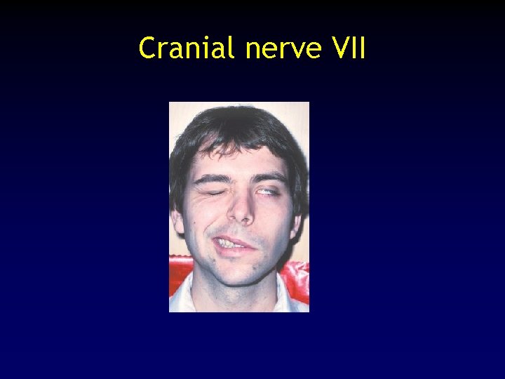 Cranial nerve VII 