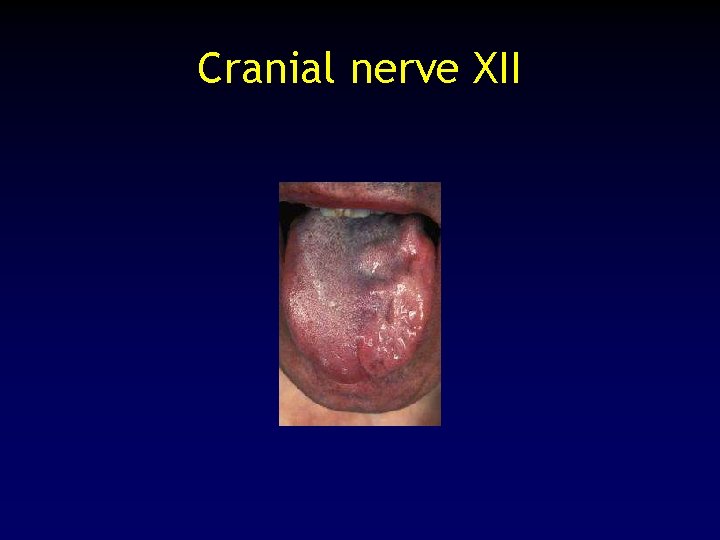 Cranial nerve XII 
