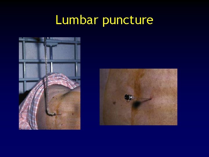 Lumbar puncture 