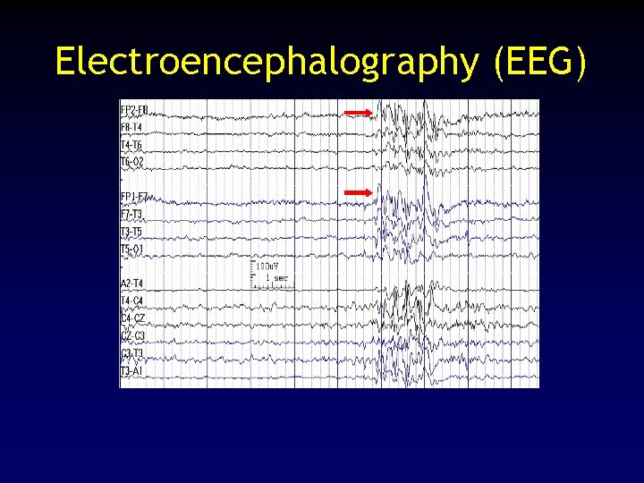 Electroencephalography (EEG) 