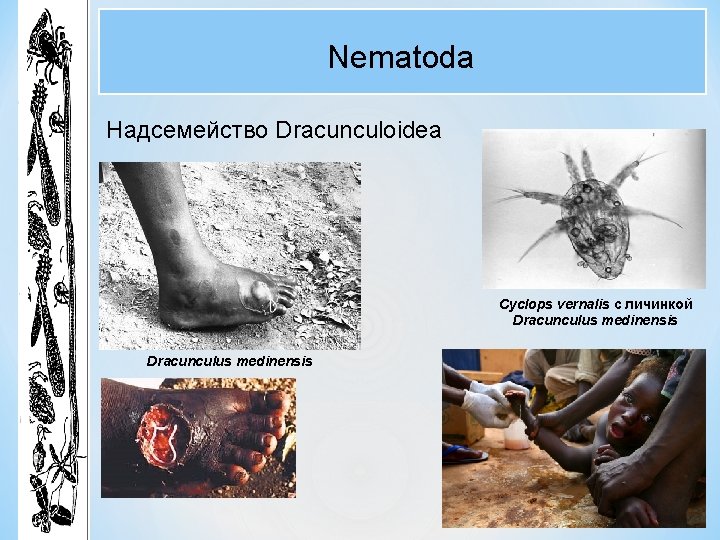 Nematoda Надсемейство Dracunculoidea Cyclops vernalis с личинкой Dracunculus medinensis 