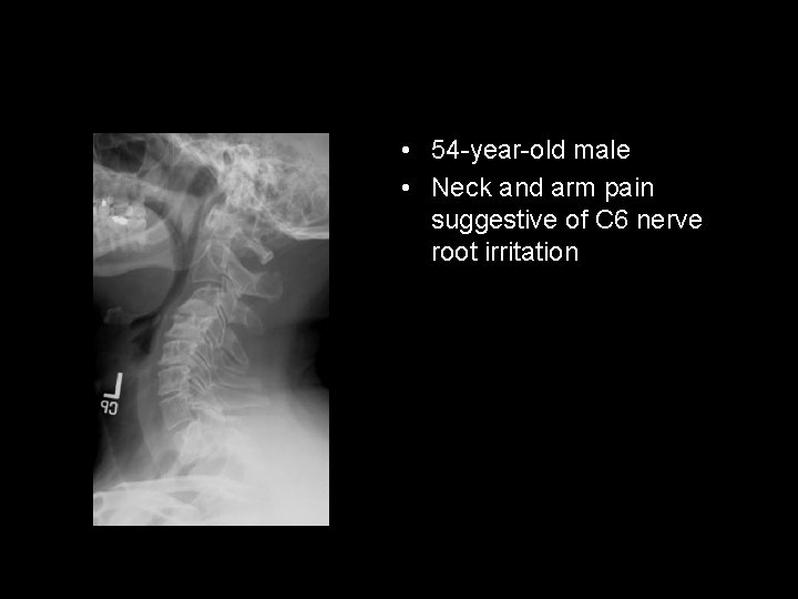  • 54 -year-old male • Neck and arm pain suggestive of C 6