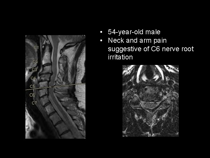  • 54 -year-old male • Neck and arm pain suggestive of C 6