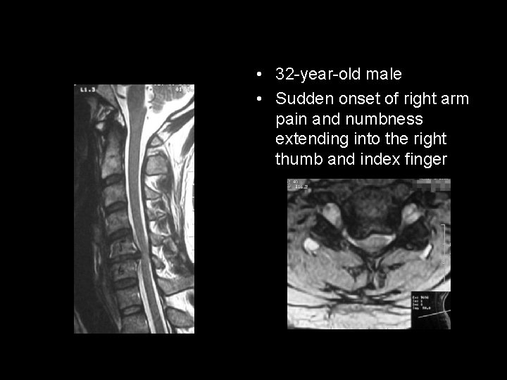  • 32 -year-old male • Sudden onset of right arm pain and numbness