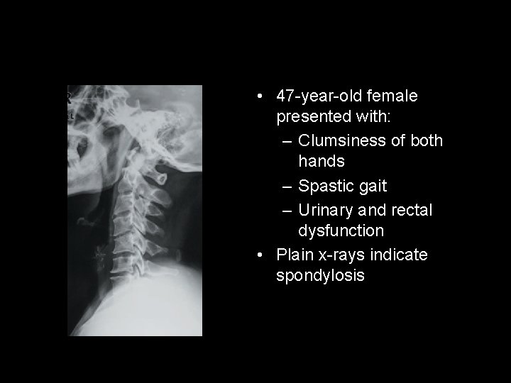  • 47 -year-old female presented with: – Clumsiness of both hands – Spastic