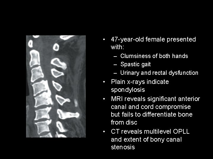  • 47 -year-old female presented with: – Clumsiness of both hands – Spastic