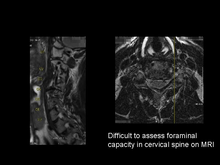 Difficult to assess foraminal capacity in cervical spine on MRI 