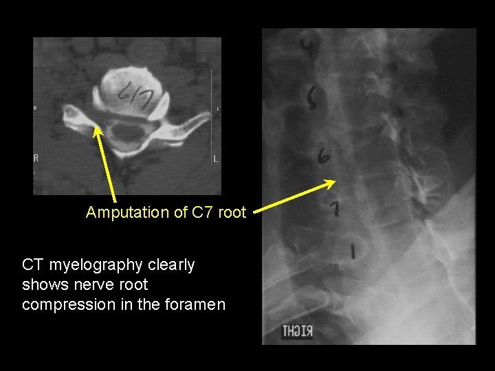 Amputation of C 7 root CT myelography clearly shows nerve root compression in the