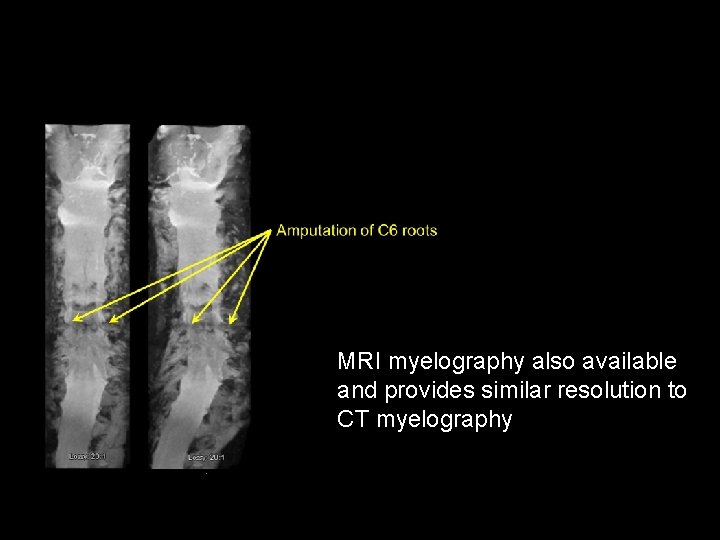 MRI myelography also available and provides similar resolution to CT myelography 