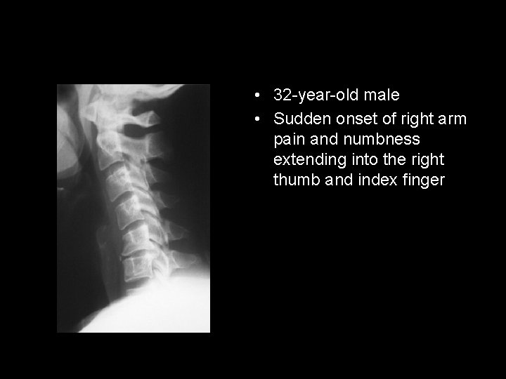  • 32 -year-old male • Sudden onset of right arm pain and numbness