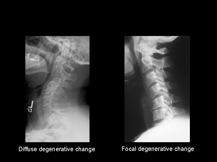 Diffuse degenerative change Focal degenerative change 