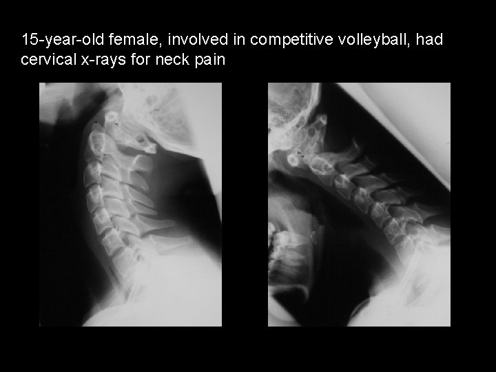 15 -year-old female, involved in competitive volleyball, had cervical x-rays for neck pain 