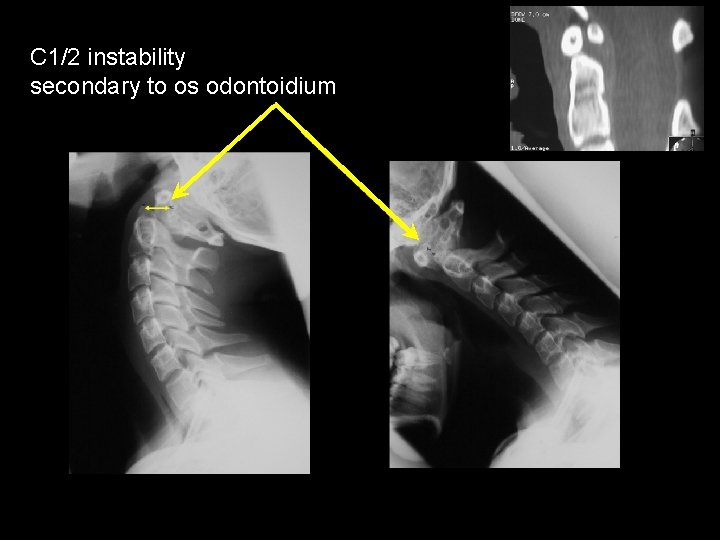 C 1/2 instability secondary to os odontoidium 