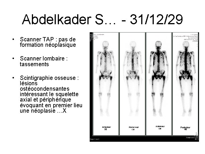 Abdelkader S… - 31/12/29 • Scanner TAP : pas de formation néoplasique • Scanner