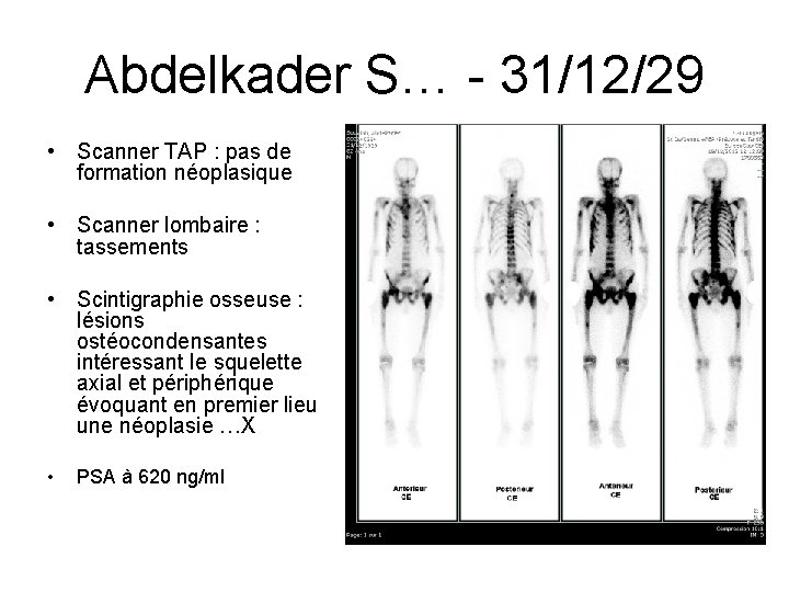 Abdelkader S… - 31/12/29 • Scanner TAP : pas de formation néoplasique • Scanner