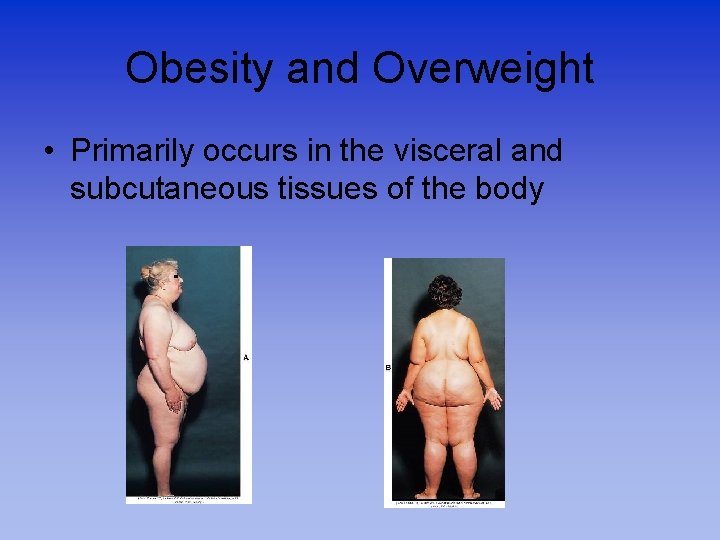 Obesity and Overweight • Primarily occurs in the visceral and subcutaneous tissues of the