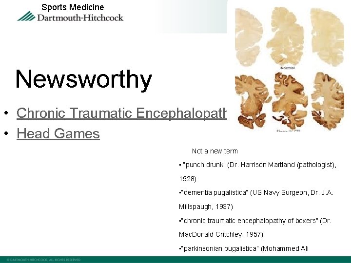 Sports Medicine Newsworthy • Chronic Traumatic Encephalopathy • Head Games • Not a new