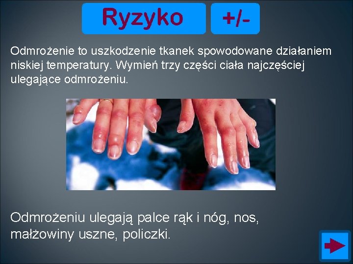 Odmrożenie to uszkodzenie tkanek spowodowane działaniem niskiej temperatury. Wymień trzy części ciała najczęściej ulegające