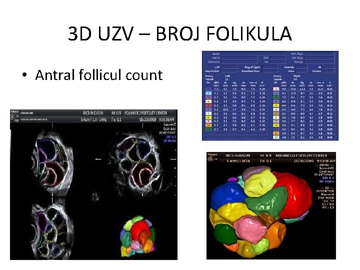 3 D UZV – BROJ FOLIKULA • Antral follicul count 