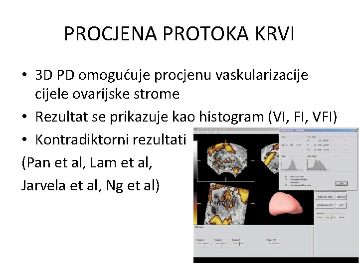 PROCJENA PROTOKA KRVI • 3 D PD omogućuje procjenu vaskularizacijele ovarijske strome • Rezultat