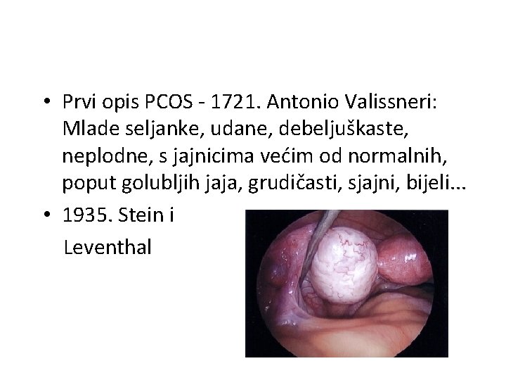  • Prvi opis PCOS - 1721. Antonio Valissneri: Mlade seljanke, udane, debeljuškaste, neplodne,