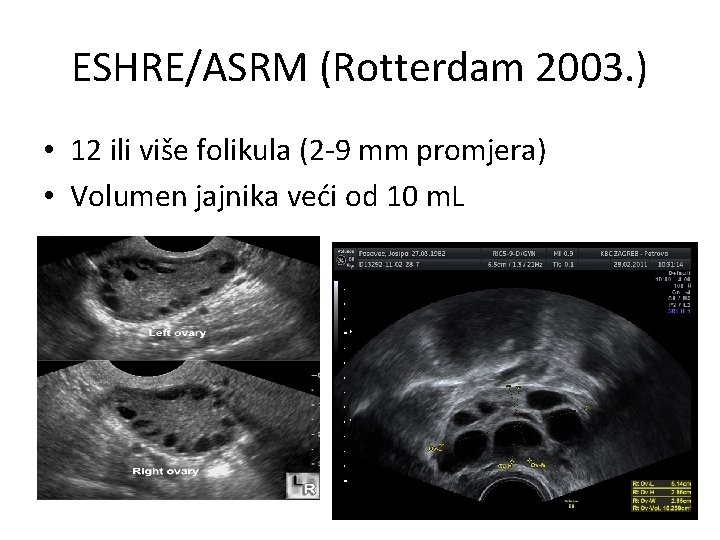 ESHRE/ASRM (Rotterdam 2003. ) • 12 ili više folikula (2 -9 mm promjera) •