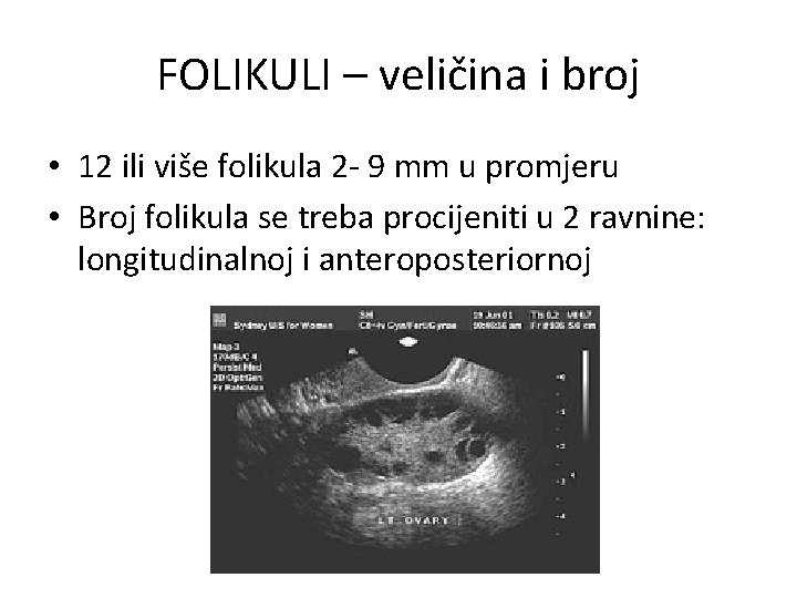 FOLIKULI – veličina i broj • 12 ili više folikula 2 - 9 mm
