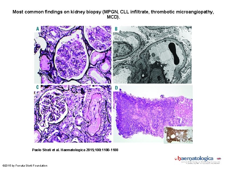 Most common findings on kidney biopsy (MPGN, CLL infiltrate, thrombotic microangiopathy, MCD). Paolo Strati