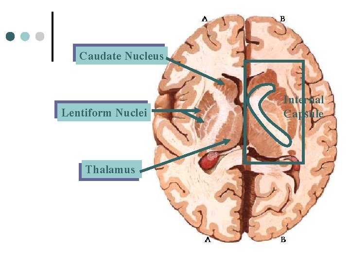 Caudate Nucleus Lentiform Nuclei Thalamus Internal Capsule 