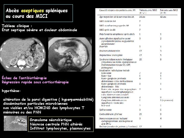 Abcès aseptiques spléniques au cours des MICI Tableau clinique : État septique sévère et