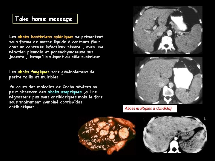 Take home message Les abcès bactériens spléniques se présentent sous forme de masse liquide