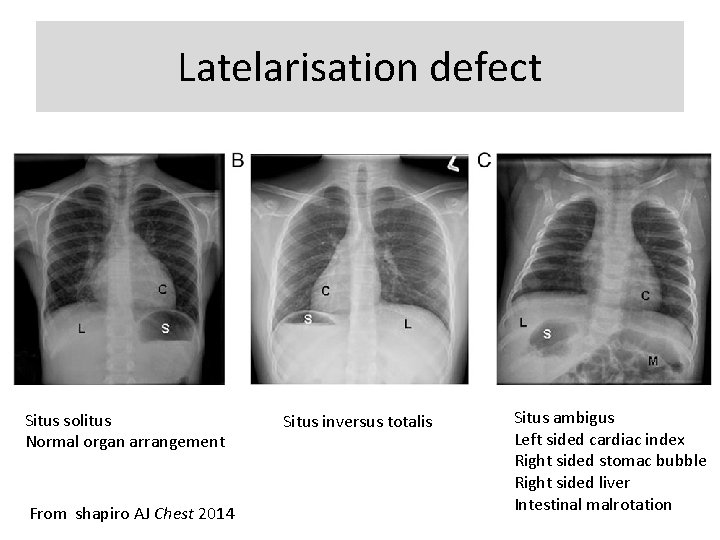 Latelarisation defect Situs solitus Normal organ arrangement From shapiro AJ Chest 2014 Situs inversus