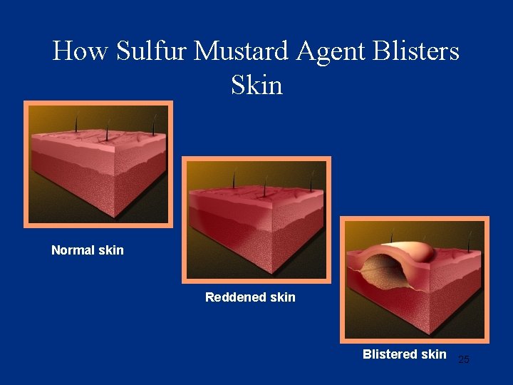 How Sulfur Mustard Agent Blisters Skin Normal skin Reddened skin Blistered skin 25 