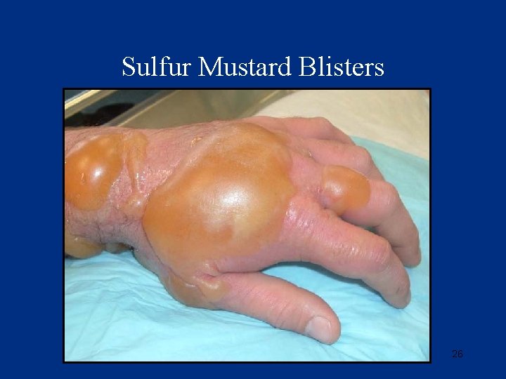 Sulfur Mustard Blisters 26 
